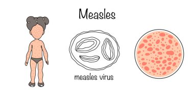Hava yoluyla bulaşan ve çocuklarda sıkça görülen son derece bulaşıcı bir virüs hastalığı. Beyaz arkaplanda tıbbi vektör.