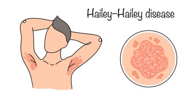 HaileyHailey hastalığı. Vücudun kıvrımlarında bulunan döküntülerle karakterize edilen nadir bir hastalık. Koltuk altlarında kızarıklık olan bir adam. Dermatoloji vektörü.