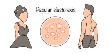 Papüler elastorexis. İyi huylu bir kursu olan kronik bir hastalık, yoğun beyaz-sarı papüller tarafından ortaya çıkarılır. Gövde ve uzuvlar. Vektör illüstrasyonu.