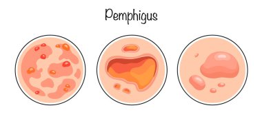 Pemphigus. Deride otoimmün patoloji ve mukoza zarları, bunlar için epitel kabarcıklar oluşur. Hastalığın dışavurumunun elle çizilmiş versiyonları. Renk vektörü illüstrasyonu.