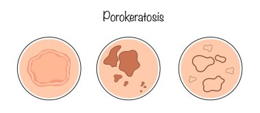 Keratinizasyon bozuklukları olarak görünen deri hastalıkları. Hastalığın birçok klinik değişkeni vardır ve bunların en yaygın belirtileri keratinli doku sınırıyla çevrili deri plakları ya da papüllerdir..