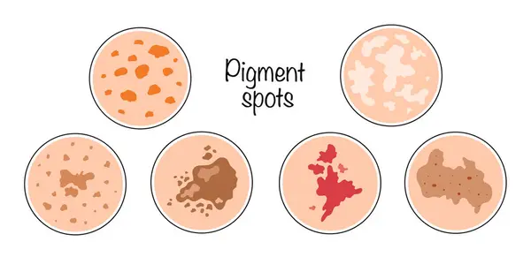 Pigment noktaları. Farklı yaş beneklerine sahip renk vektörü çizimi. Deri oluşumları. Tıp ve kozmetoloji alanlarında kullanılmak üzere illüstrasyon.