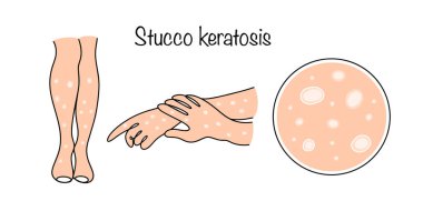 Kollarında ve bacaklarında Stucco keratosis var. Kökeni bilinmeyen bir deri hastalığı, gümüş beyazı kabuklu kerotik papullerin oluşumuyla ortaya çıkar. Renkli tıbbi vektör.