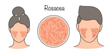 Rosacea. Yüz ve dcollet derisinin kronik bulaşıcı olmayan patolojisi. Yanaklarında sarkık hastalık olan insanlar. Beyaz arkaplanda renk vektörü çizimi.