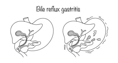 Midede onikiparmak bağırsağı içeriğinin retrograd reflüsünden kaynaklanan mide mukozasında hasar var. El yapımı gastrointestinal hastalık. Vektör illüstrasyonu.