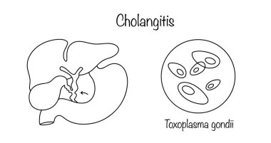 Kolanjit. Karaciğer ve safra kesesini ince bağırsağın üst kısmına taşıyan drenaj sisteminin iltihaplanması. İltihaplanmanın nedeni toksoplazmoz..