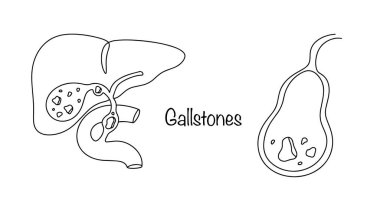 Safra taşı. Safra kesesi ve safra kesesi ve safra yolunda sert taşların oluşumuna eşlik eden kronik bir hastalık. Elle çizilmiş safra taşı ve kanalları. İzole edilmiş siyah-beyaz vektör.