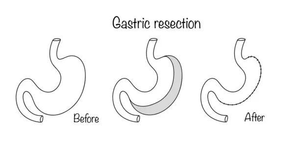 stock vector An operation in which a large part of the stomach is removed, after which the continuity of the digestive tract is restored. Reducing the size of the stomach for medical reasons. Medical operation.