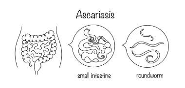 Ascariasis. Yuvarlak solucanlarla enfekte olduğunda gelişen helminik bir hastalık. İnsan bağırsağının içindeki parazitler. Mide-bağırsak yolu hastalığı. Vektör.