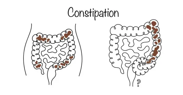 stock vector Constipation. A decrease in the frequency of bowel movements that a person is used to and difficult passage of feces. Medical vector. Vector.