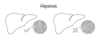 Hepatoz. Karaciğer hücrelerinde (hepatosit) metabolik bozukluklar ve karaciğer hücrelerinde disrofik değişimler. Karaciğer ve karaciğer ve hepatozlu. Basit vektör illüstrasyonu.