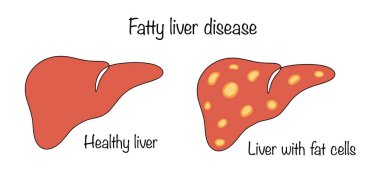 Sağlıklı karaciğer ve yağ hastalığı. Hepatositlerde aşırı yağ molekülü birikmesi. Karaciğer hastalığı alkol tüketimiyle ilgili değil. Basit renk vektörü çizimi.