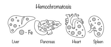 Hemokromatozis. Vücudun çok fazla demir emdiği ve depoladığı kalıtsal bir durum. Vücutta aşırı demir biriktiren ana insan organları. Farklı kullanımlar için vektör illüstrasyonu.