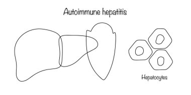 Vücudun bağışıklık sisteminin karaciğere saldırıp iltihaplanmasına neden olan bir hastalık. Bağışıklık sistemi karaciğeri kendi sağlıklı hücrelerinden korur. Tıbbi el çizimi vektörü.