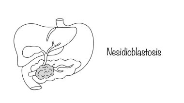 Nesidioblastosis. A pathological condition characterized by excess production of insulin due to tumors of pancreatic cells. Hand drawn medical illustration. Vector. clipart