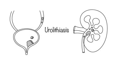 Urolithias. Metabolik bozukluklarla karakterize edilen kronik bir hastalık. Böbreklerde ve idrar yollarında taş oluşumu. İdrar bileşenlerinden oluşmuş. Yaygın bir hastalık.