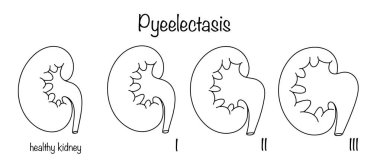 İdrar sisteminin patolojisi. Böbrek leğen kemiğinin, idrar birikiminin sonucu olarak genişlemesi. Hastalığın farklı aşamalarında sağlıklı bir böbrek ve böbrek. Vektör.