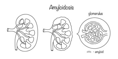 Böbrek dokusunda protein-karbonhidrat metabolizmasının bozulduğu ve özel çözünmez protein amiloidin biriktiği bir hastalık. Böbrek hastalığı hakkında tıbbi çizimler.