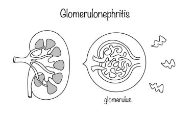 Glomerulonefrit. Kanı süzen glomeruluyu etkileyen bir böbrek hastalığı. Beyaz arka planda el çizimi çizimi çizimi. Vektör illüstrasyonu.