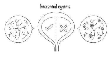 İnterstiktik sistit. İdrar kesesi dokusunda yıkıcı iltihap değişikliklerinin eşlik ettiği bir hastalık. Ağrıya, sık idrara ve idrar tutamamaya neden oluyor. Mesane dokusunda elle çizilmiş değişiklikler