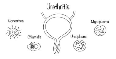 Uretrit. Bulaşıcı bir doğanın üretra iltihaplı hastalığı. Mesanenin elle çizilmiş bir örneği ve hastalığa neden olan ana enfeksiyonlar. Vektör illüstrasyonu.