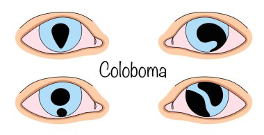 Coloboma. Az gelişmişliğin meydana geldiği göz zarının bütünlüğünü doğuştan ya da sonradan kazanılan bir ihlal. Koloboma tezahürünün elle çizilmiş versiyonları. Vektör illüstrasyonu.