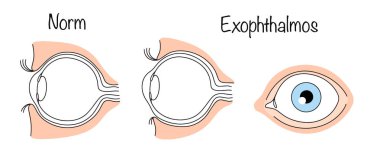 Göz kürelerinin yuvalardan aşırı şekilde dışarı çıkmasının bir durumu. Göz küresi ve exophthalmos 'un doğru konumu. Farklı kullanımlar için tıbbi vektör.