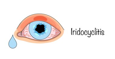 Iridocyclitis. İris iltihabı ve göz küresinin siliyer bedeni. Hastalığa göz yaşı dökülmesi ve göz bebeklerinde değişiklikler eşlik ediyor. Optalmoloji teması üzerine vektör illüstrasyonu.