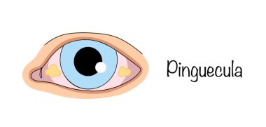 Pinguecula. Gözün konjonktivasında neoplazmalar sarımsı bir büyüme şeklinde. Göz hastalıkları konusunda basit bir renk vektörü çizimi.