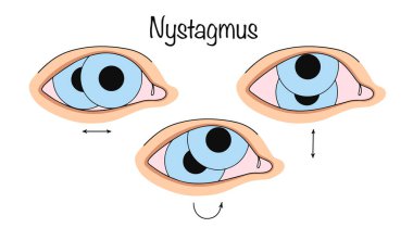 Nistagmus. Titremeler ya da tekrarlanan, kontrol edilemeyen, yüksek frekanslı göz yuvarlarının ritmik seğirmesi. İstemsiz göz hareketi varyasyonları ile renk vektör illüstrasyonu.