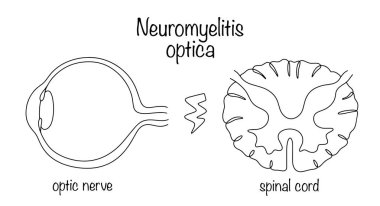 Nöromiyelit optika. Optik sinir ve omurilik nöronlarının miyelin kılıfını etkileyen bir hastalık. Farklı kullanımlar için tıbbi vektör.