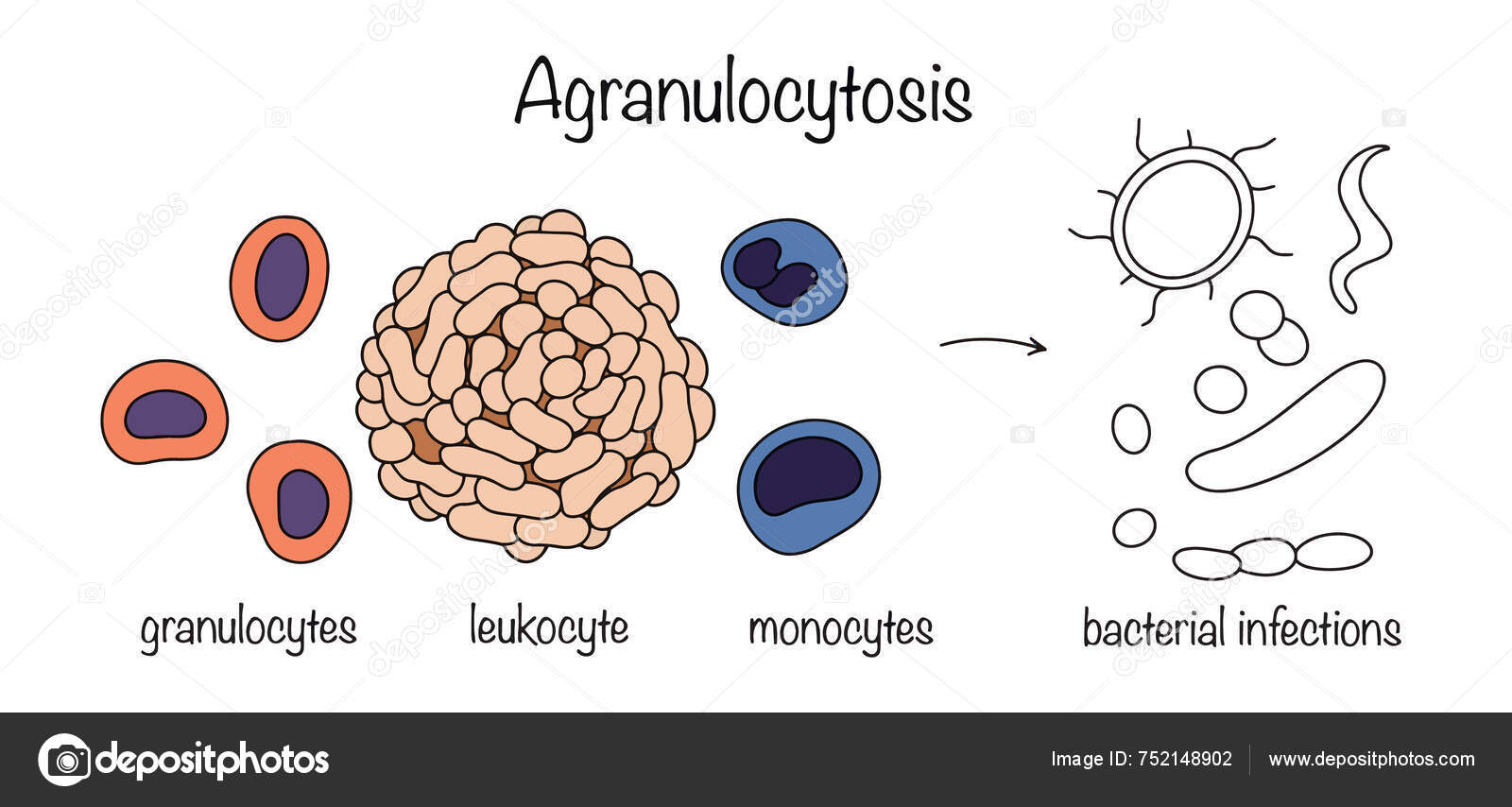 État Pathologique Caractérisé Par Une Diminution Taux Leucocytes Granulocytes Monocytes Pour Cette Raison Sensibilité Corps Aux Infections Bactériennes Fongiques Augmente