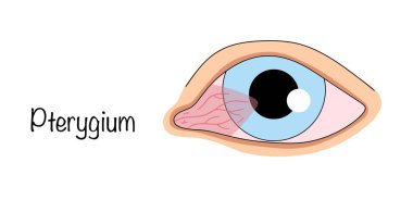 Pterygium. Konjonktivite hastalığı. Korneanın üzerindeki büyümesiyle karakterize edilen bir hastalık mı? Gözüm. El çizimi renk vektörü çizimi.
