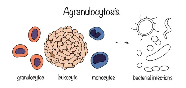 État Pathologique Caractérisé Par Une Diminution Taux Leucocytes Granulocytes Monocytes Pour Cette Raison Sensibilité Corps Aux Infections Bactériennes Fongiques Augmente