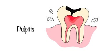 Pulpitis. A disease associated with the process of inflammation in the pulp inside the tooth. Tooth with pulpitis for use in dentistry. Vector illustration. clipart