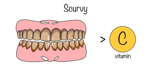 stock vector Scurvy. A disease caused by a lack of vitamin C. Drawn damaged teeth as a result of an acute lack of ascorbic acid in the human body. Vector illustration.