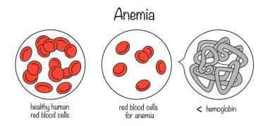Anemi var. Alyuvar sayısı ve hemoglobin yoğunluğundaki azalma ile karakterize edilen bir kan hastalığı. Sağlıklı bir insandan alınan kan ve anemiden alınan kanın renk vektör çizimi.