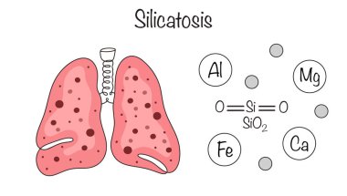 Silikatoz. Pnömokonioz grubundan gelen bir insan hastalığı. Metal oksitli silisik asit bileşikleri içeren uzun süreli toz solunumundan kaynaklanıyor. Vektör illüstrasyonu.