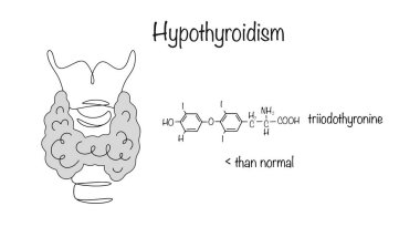 Hipotiroidizm. Tiroid hormonlarının yetersiz üretilmesiyle ortaya çıkan endokrinolojik bir hastalık. El yapımı tiroit bezi ve vücutta eksik olan ana hormon. Vektör illüstrasyonu.