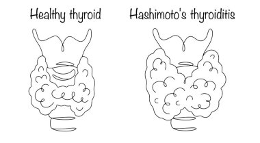 Hashimoto's thyroiditis. Chronic inflammatory pathology of the thyroid gland of autoimmune origin. Line drawing of a healthy thyroid gland and an enlarged thyroid gland due to disease. Vector. clipart