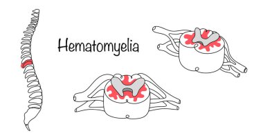 Hematomyelia. Yaralanma ya da şiddetli kas gerilimine bağlı olarak omurilikte kanama var. Beyaz arkaplanda tıbbi vektör.