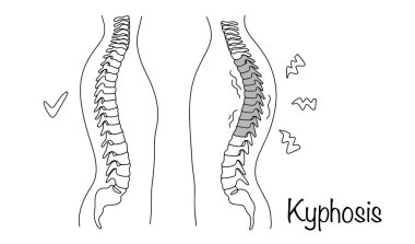 Omurilikte en yaygın deformasyonlardan biri, omurga sırtında aşırı derecede dışbükülmüş bir şekil var. Omurga ve kifoz sağlıklı. İzole vektör.