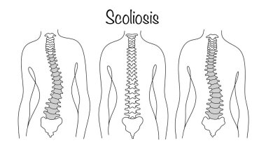 Skolyoz. Omurganın eksenine göre eğriliği. Sırtı sağlıklı bir adam ve omurga eğriliği olan bir adam. Tıbbi bir tema üzerine çizilmiş çizgi çizimi. Vektör.