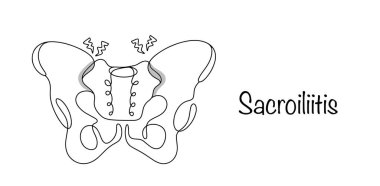 Sacroiliit. Sakroiliak eklem iltihabının oluştuğu bir hastalık. Hastalığın yerini gösteren çizgiler çizilmiş. Beyaz arkaplanda izole edilmiş vektör.