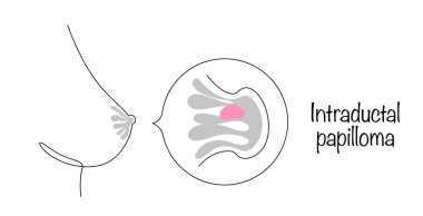 Intraductal papilloma. A hand-drawn breast with a benign lump inside the milk ducts. Medical vector on the theme of mammological diseases. clipart