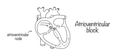 Atrioventriküler blok. Atriden ventriküllere giden elektriksel impulsların iletiminde bozulma. Kalp rahatsızlığını gösteren bir çizgisi olan tıbbi illüstrasyon. İzole vektör.