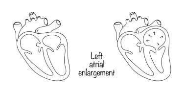 Enlargement of the left atrium in as a result of prolonged overload of the cardiac chamber. A healthy heart drawn with a black line and a heart with left atrium dilatation. Vector illustration. clipart