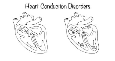 Atria ve ventrikül içindeki sinir demetleri boyunca yayılan elektriksel impulslarda bozulma. Sağlıklı kalp ve iletken bozuklukları olan bir kalp çizildi. Tıbbi çizgi vektörü.