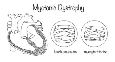 Miyotonik distrofi. Kalp kaslarında iltihaplanmayan hasar, miyositler incelmeye başlar. Miyokardiyumu vurgulanmış, sağlıklı ve deforme olmuş bir kalp. Vektör.