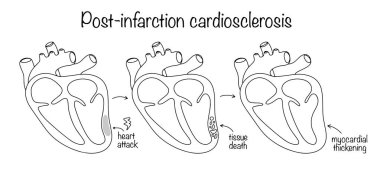 Consequences of a heart attack in the form of tissue death and thickening of the myocardial wall. Drawn stages of the development of cardiac pathology. Simple vector medical diagram. clipart